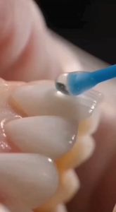 10pcs Dental Disposable Adhesive Tip Applicator for Tooth Crown Porcelain Veneer