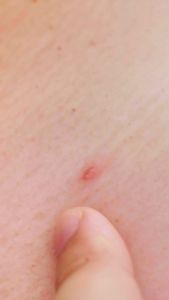 Sactea Soap Bar Skinsane Mengatasi Masalah Jerawat dan Mengurangi Minyak Pada Wajah