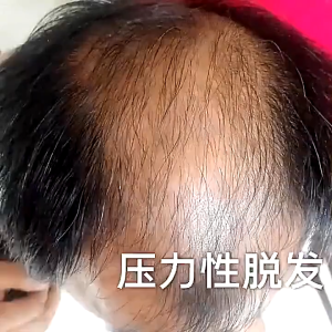 GROSIR KOSMETIK SAMPO JAHE PENUMBUH RAMBUT BOTAK ANTI RONTOK KETOMBE TERCEPAT PRIA WANITA EXTRACT GINGER HERBAL ALAMI ANTI GATAL