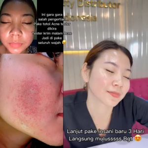 INSANI SKINCARE BPOM ACNE GLOW SERIES BPOM SUPER DISTRIBUTOR JAKARTA PERAWATAN WAJAH KRIM FLEK KUSAM JERAWAT BERJERAWAT BRUNTUSAN BEKAS JERAWAT