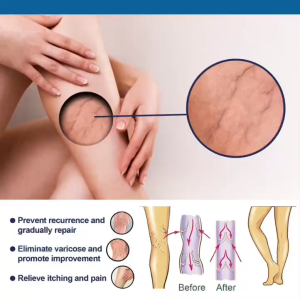 Chai Xịt Loại Bỏ Suy Giãn Tĩnh Mạch Giảm Cơn Đau Lưu Thông Máu Không Gây Khó Chịu Phù Hợp Với Mọi Người