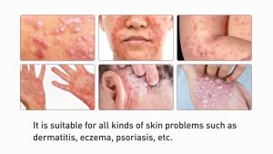 EFFECTIVE SUMIFUN ECZEMA CREAM ANTI BACTERIAL CREAM I FOR PSORIASIS DERMATITIS ITCHY SKIN I 20G