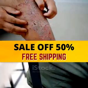 Herbal Anti-Bacteria Cream: A Natural Solution for Psoriasis & Eczema