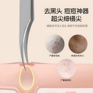 3 Cụ Tẩy Tế Bào Chết Siêu Nhọn Mới Chuyên Dụng Cho Phòng Làm Đẹp Cụ Tẩy Đầu Đen Cụ Tẩy Mụn Hình Chú Đập Biển