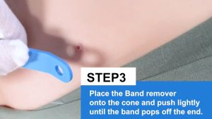 Alat Penghilang Kutil & Lalat: Pemahaman Lengkap