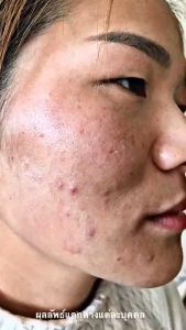 อินเฟรช Infresh เซรั่มหลุมสิว ราคาพิเศษ สำหรับชุดเครื่องคอมพิวเตอร์ อินเฟรช ไวท์เทนนิ่ง เซรั่ม ลดการเกิดหลุมสิว