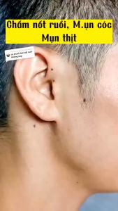 Gel Xoá Nốt Ruồi tàn nhang