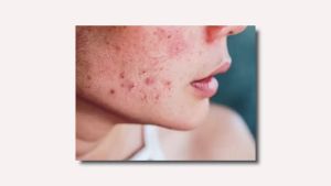 The Ordinary Salicylic Acid 2% Face Serum Pore control Minimizer Acne Pimple Blackhead Remover Exfoliating skincare Oil control smooth skin