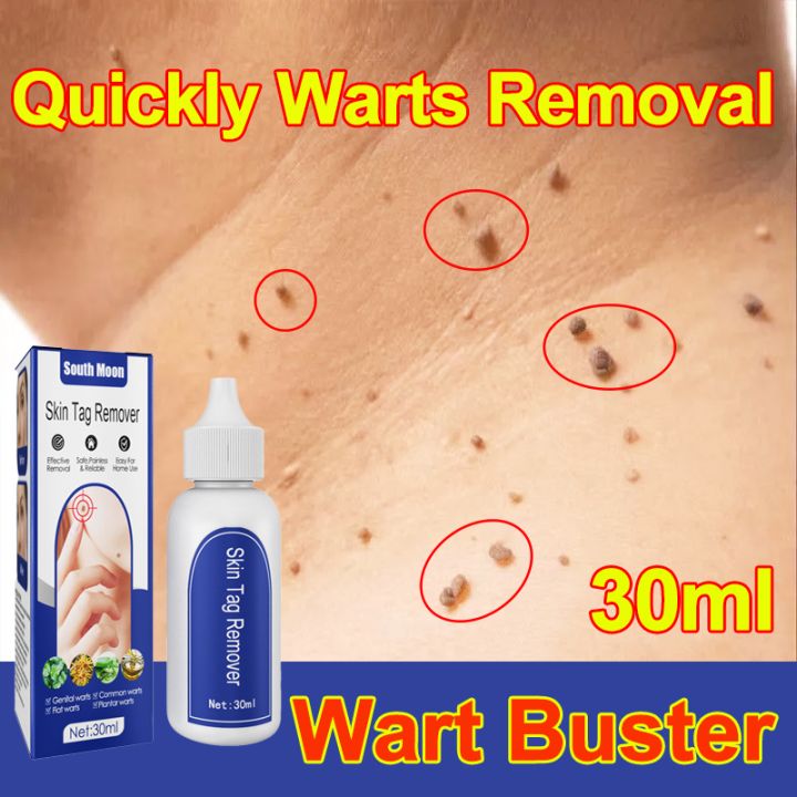 💯Wart Killer💯 Wart Removal Original 30ml, Effectively removes and heals common warts, plantar warts, flat warts, genital warts, and other viral infections on the skin. Wart Removal Cream，Fast removal, painless removal, no recovery.