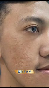 Essence Serum Dr. FAY Radiance - Penghilang Flek & Jerawat Travel Size