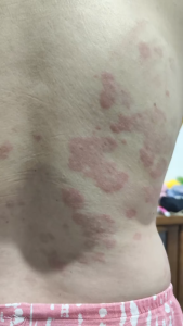 [ EXFOLIATING + ANTI PIMPLE ] Greenika Oatmeal & Honey Soap Anti Pimple Controls Breakouts Removes Excess Oil Itchy Skin Safe and Anti Allergies Removes heals Active Wounds and Scars Gentle on Skin Acne Solution for All Skin Types Good Sensitive Skin Safe