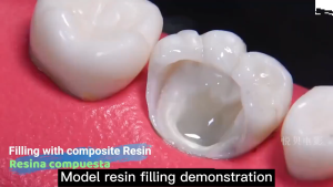 A1 A2 A3 General Purpose Dental Light Curing Material for Fillings and Restorations
