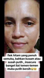 Paket Skincare Flek Tanpa Toner Orlin Beauty Mencerahkan Wajah Mengencangkan Kulit Memudarkan Noda Hitam Bpom