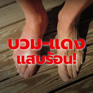 nova ลดกรดยูริค 1 แถม 1 อาการปวด บวม แดง ที่ข้อ