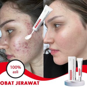 Cream Anti Acne obat jerawat dan bekas jerawat penghilang jerawat 15g Jerawat Removal of Acne Cream Untuk Pria dan Wanita Menghilangkan