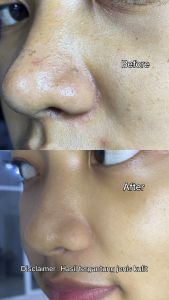 Azrina Mugworth To Try Clay Mask - Masker Wajah Acne Wanita Pria Untuk Mencegah Tumbuh Jerawat Dan Membersihkan Komedo