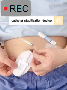 Medical Sterile Peritoneal Dialysis Catheter Fixed Patch Urinary Catheter Puncture Bile Catheter Fixed Patch
