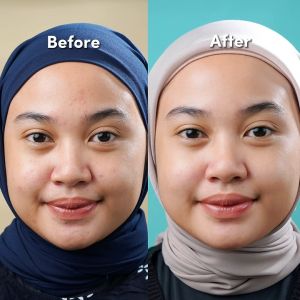 FOCALSKIN Acne-Care Essence Ampuh Untuk Jerawat 15g