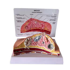 Pathological Breast Model Teaching Aids for Breast Anatomy Lymph Node Cancer Human Body Teaching Touch Model PVC Environmental Protection Grade