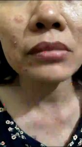 Kem Nấm Ngứa NHẬT BẢN bôi Hắc Lào Tổ Đỉa