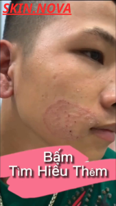 Kem Bôi Nấm Ngứa Viêm Da Cơ Địa NHẬT BẢN Hắc Lào Tổ Đỉa Vẩy Nến Á Sừng Lang Ben Hiệu Quả
