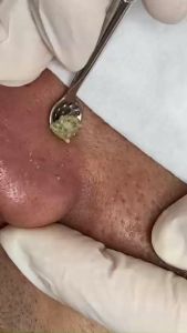 Thìa Lấy Mụn Thìa Cạo Mụn