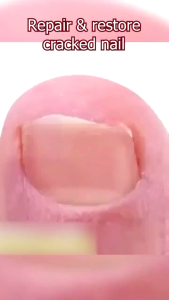 Ubat kuku rosak ingrown toenail Drops Nail Repair Serum nail fungus treatment ubat kuku cekam Nail Repair Essence Serum Relief Swelling Pain Paronychia Pain 甲沟炎嵌甲灰指甲