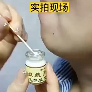 【Buy 1 Take 1】Concentrated potent skin tag removal cream Body Warts Cream Natures Miracle Warts Remover Original Mole Remover Skin Tag Remover Kasoy Cream Wart Removal