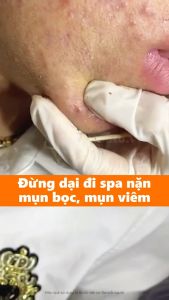 Kem Hỗ trợ giảm mụn Làm Trắng Da Loại bỏ thâm mụn Zhx