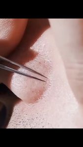 เครื่องดูดสิวเครื่องกำจัดสิวหัวดำที่กดสิวละเอียดมากสำหรับมืออาชีพ