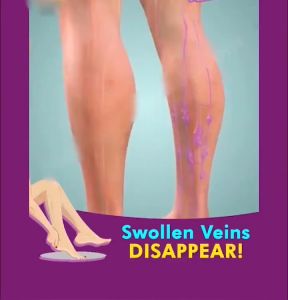 VARICOSE VEINS Cream hilangkan urat bengkak urat angin urat vein repair treatment cream vein repair cream leg pain relie