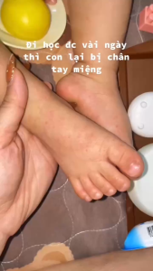 SET 3 TUÝP - [SIÊU HOT] Kem Bôi Dị Ứng Dịu Da Bé – Thoa Là Mát Bôi Là Êm Chiết Xuất Thảo Dược Dễ Dàng Sử Dụng Hiệu Quả Và An Toàn