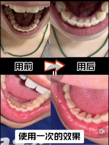 ❤ ️ พร้อมส่ง ❤ ️ มีดโกนหินปูนไฟฟ้า แปรงสีฟันปรับ 3 สปีด ขจัดคราบบนพื้นผิวฟัน มีดโกนหินปูนไฟฟ้า ไม่เจ็บฟัน