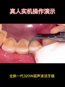 Ultrasonic Dental Scaler Cleaning Dental Calculus Electric Dental Scaler Household Tooth Whitening Instrument