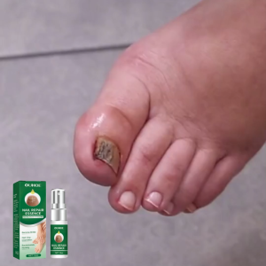 Ouhoe Nail Repair Essence Quickly Repair Damaged Nails Effective Fungus Removal Onychomycosis Treatment Anti Fungal Nail Solution Hand Foot Skin Care 10ml