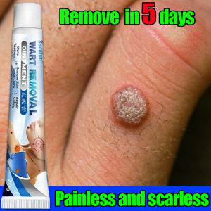 Remove in 5 days👍sumifun wart removal cream 20g effective in removing all kinds of warts naturally painlessly and completely(Warts Remover Original Cream painless kulogo remover Wart remover Ointment wart remover cream Wartz Removal )