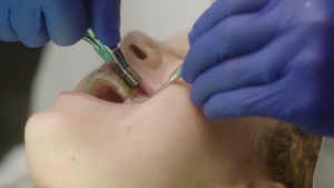 Behel Metal Ortho Metal Bracket I Morelli Roth Hook C P1 P2  Nano Slot 022" Canine 9 ° I Only For Professional