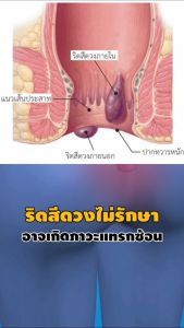 หมอวรัญญู ครีมทาริดสีดวง 30ml. ติ่งยุบ แห้ง ฝ่อเร็วขึ้น คนท้อง ให้นมบุตร ใช้ได้