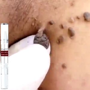 Penghilang Tahi Lalat & Kutil di Leher & Wajah
