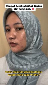 【100% Efektif】CHALONESE Paket Skincare BPOM 9 in 1 + 8 IN 1Paket Glowing BPOM Paket Skincare Cream Whitening Moisturizer Sunscreen SPF50+++ Facial Wash Skin Care Wajah