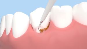 Dental Scaler Tooth Brush Electric 2 In 1 Electric Ultrasonic Dental Scaler Toothbrush Home Teeth Cleaner IPX6 Waterproof USB Charging Portable Tartar Calculus Remover Dental Tools teeth scaling tools for Teeth Whiteing 电动牙刷