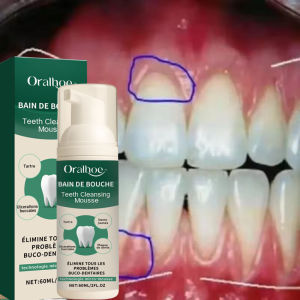 oralhoe | Rapid Repair Gums Mousse Effectively Relieve Tooth Allergy Dental Caries Tooth Cleaning Toothpaste Relieve Tooth Damage Drops