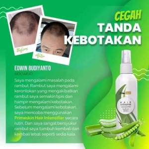 Mengatasi kerontokan pda rambut dan kebotakan pda rambut