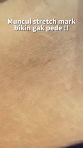 Vienna - Stretch Mark Cream Krim Pemudar Stretch Mark Krim Hamil Perawatan Peregangan Kulit (30ml / 80ml)