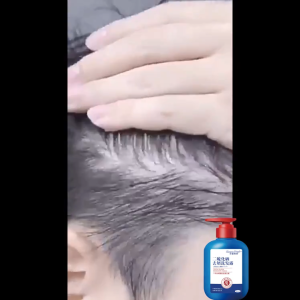 Selenium disulfide anti-dandruff shampoo 300ML helps to quickly relieve itching and helps your scalp shed naturally restoring dermatitis