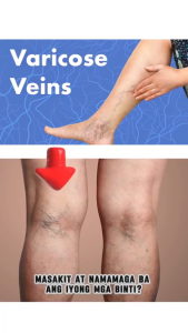 BEST SELLER Varicose Vein Cream 20G - Varicose Vein Remover Cream For Legs Soothing Care | Leg Care Cream For Spider Veins & Swelling | Effective Leg Soothing Cream For Varicose & Spider Veins | Varicose Veins Remover Cream Spider Vein Ugat Cream