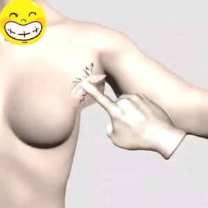 Kem tan mỡ chính hãng cho nhiều cục u dưới da đơn lẻ u tuyến giáp u mỡ hiệu quả Loại bỏ u mỡ không đau 30g