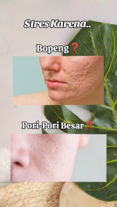 Skincare Solusi Wajah Bopeng / Scar Acne Paket Bopeng Sr12 Sabun Bulus Revitalizing Serum & Sunsreen