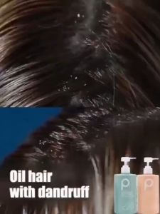 shampoo kelemumur anti dandruff shampoo dandruff treatment oil control sea salt Shampoo syampoo kelemumur syampu 去屑洗发露 Deep clean scalp reduce dandruff hair treatment removes mites Scalp Care scalp Relieve itchy scalp anti hair loss shampoo - Lazada