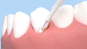 【FAST Delivery】Teeth Cleaner Tartar Ultrasonic Tooth Cleaner Machine Teeth Whitening and Tartar Remover Dental Scaler for Teeth Usb Electric Tooth Brush Electric Ultrasonic Toothbrushes for Adult